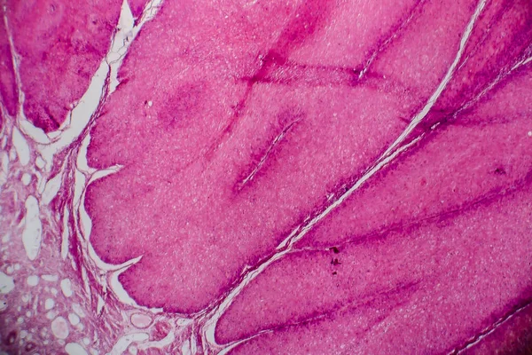 Condyloma Acuminatum Auch Bekannt Als Genitalwarzen Lichtmikroskopie Foto Unter Dem — Stockfoto