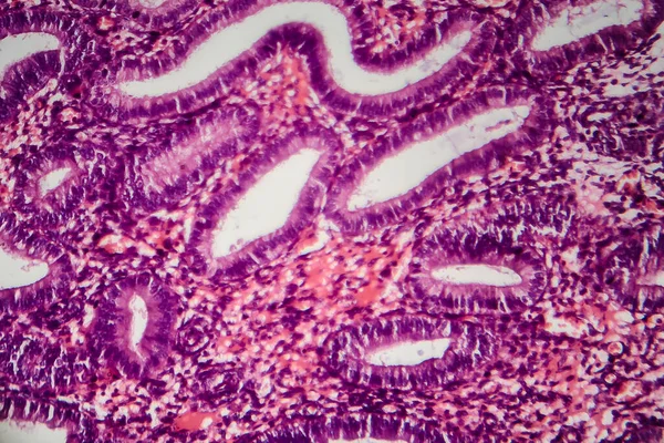 Endometrioza Zaburzenie Którym Komórki Podobne Tych Endometrium Rosną Poza Macicą — Zdjęcie stockowe