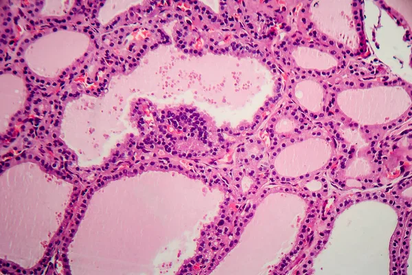 Bocio Endémico Micrografía Ligera Aumento Anormal Glándula Tiroides Debido Deficiencia — Foto de Stock