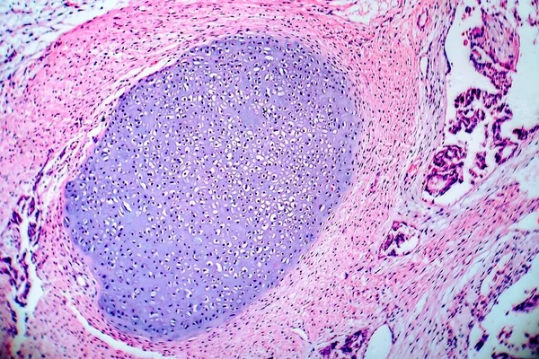 Light Micrograph Teratoma Tumor Made Several Different Types Tissue Hair — Stock Photo, Image