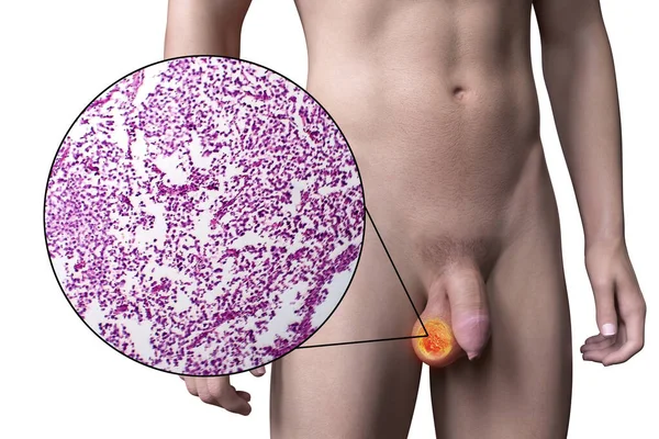 Testiculaire Kanker Testiculair Seminoom Medische Illustratie Licht Micrograaf Kwaadaardige Tumor — Stockfoto