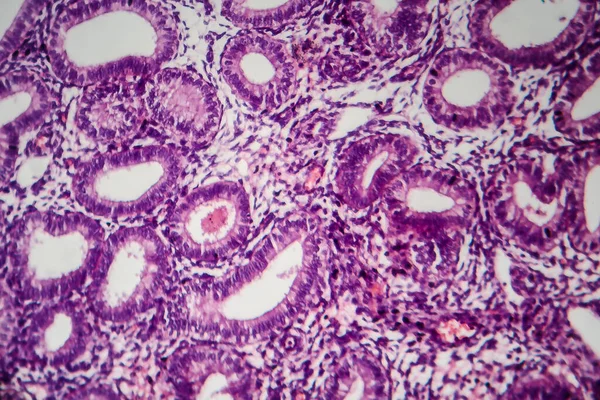 Endometriose Distúrbio Que Células Semelhantes Endométrio Crescem Fora Útero Micrografia — Fotografia de Stock