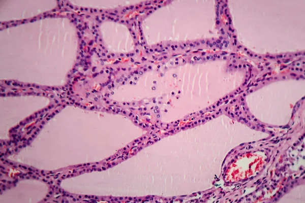 영양성 갑상선종 가벼운 현미경 요오드 결핍으로 갑상선의 비정상적 광물학적 콜로이드 — 스톡 사진
