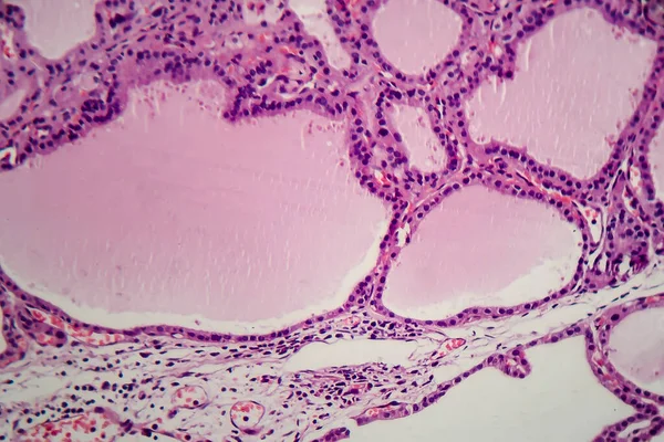 Bocio Endémico Micrografía Ligera Aumento Anormal Glándula Tiroides Debido Deficiencia —  Fotos de Stock