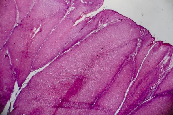 先天性ワーツとしても知られているCondyloma Acuminatum 顕微鏡下の写真 — ストック写真
