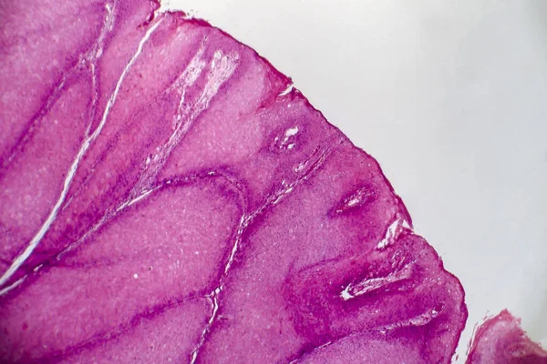 尖锐湿疣 也称为生殖器疣 光学显微镜 显微镜下照片 — 图库照片