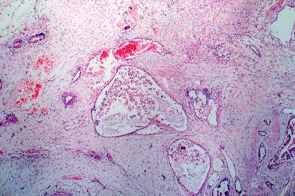 Light Micrograph Teratoma Tumor Made Several Different Types Tissue Hair — Stok fotoğraf