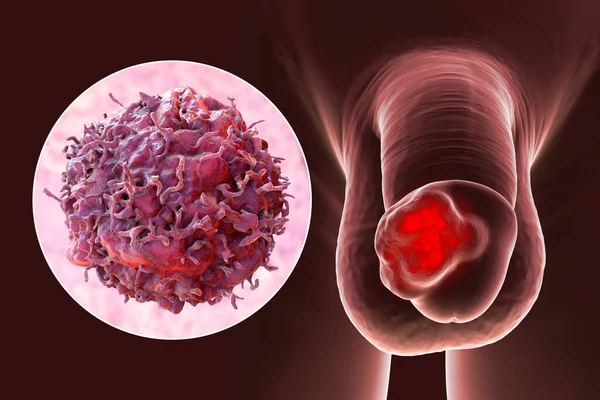 Penile Cancer Illustration Showing Malignant Tumor Human Penis Close View — Zdjęcie stockowe