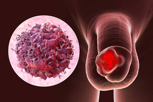 Penile cancer, 3D illustration showing malignant tumor on the human penis and close-up view of a cancer cell