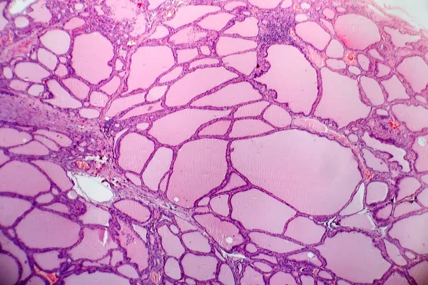 Bocio Endémico Micrografía Ligera Aumento Anormal Glándula Tiroides Debido Deficiencia — Foto de Stock