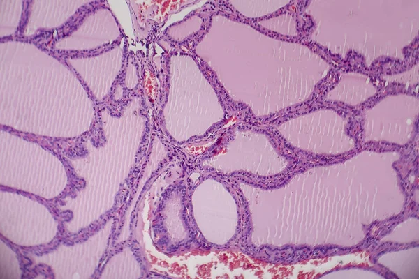 Bocio Endémico Micrografía Ligera Aumento Anormal Glándula Tiroides Debido Deficiencia — Foto de Stock