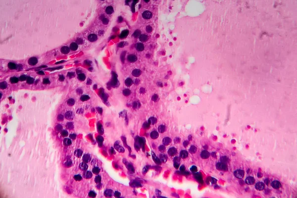 Endemische Struma Lichte Micrograaf Abnormale Vergroting Van Schildklier Als Gevolg — Stockfoto