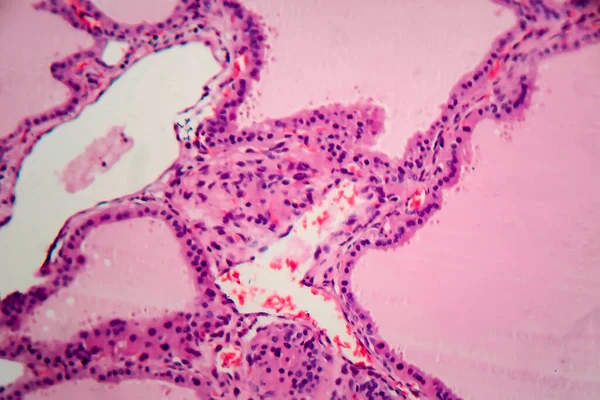 Bocio Endémico Micrografía Ligera Aumento Anormal Glándula Tiroides Debido Deficiencia —  Fotos de Stock