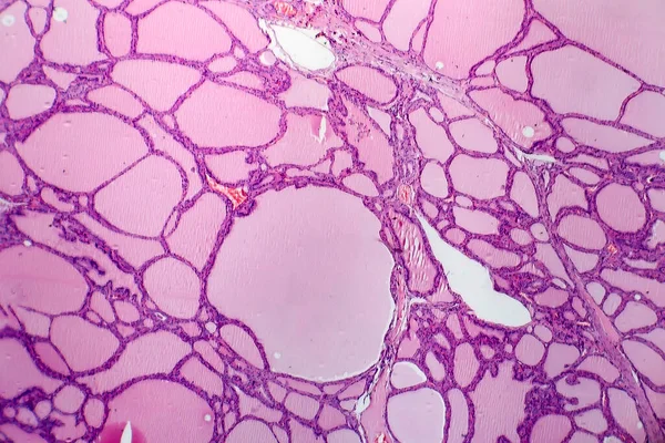 영양성 갑상선종 가벼운 현미경 요오드 결핍으로 갑상선의 비정상적 광물학적 콜로이드 — 스톡 사진