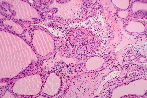 内因性甲状腺腫 軽いマイクログラフ 食事ヨウ素欠乏による甲状腺の異常な拡大 写真マイクログラフは さまざまな大きさ 豊富なコロイド リンパ球性浸潤の卵胞を示しています — ストック写真