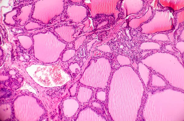 毒性弥漫性甲状腺肿 或Graves病 一种影响甲状腺的自身免疫性疾病 光镜显示甲状腺滤泡增生 胶质减少 — 图库照片