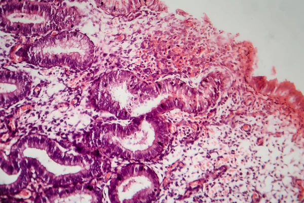 Ενδομητρίωση Μια Διαταραχή Στην Οποία Κύτταρα Παρόμοια Αυτά Στο Ενδομήτριο — Φωτογραφία Αρχείου