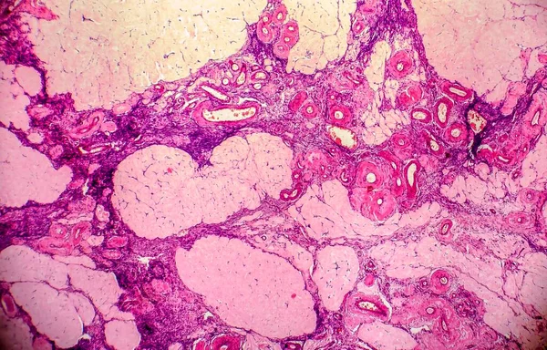 Ovarian Cyst Light Micrograph Photo Microscope Фотографія Показує Фрагмент Кісти — стокове фото