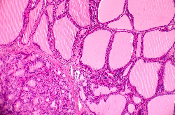 Toksik Difüzyon Guatrı Graves Hastalığı Tiroidi Etkileyen Otoimmün Bir Hastalık — Stok fotoğraf