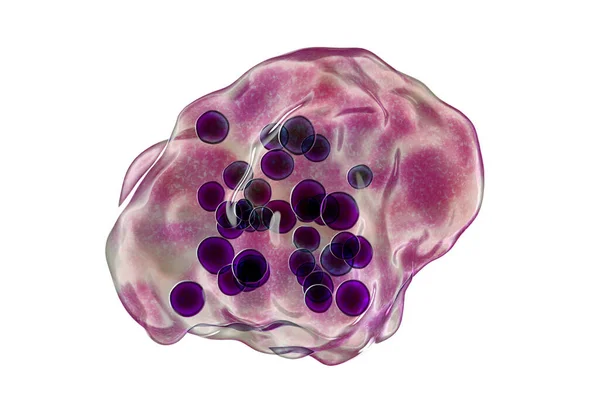 Maladie Rougeoleuse Cellules Multicucléées Géantes Observées Lors Microscopie Échantillons Biopsie — Photo