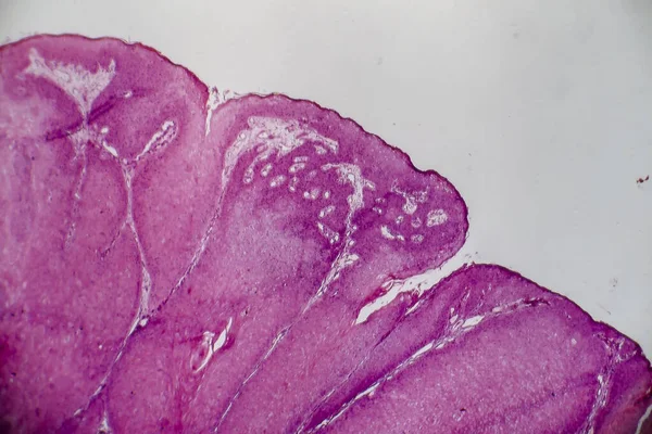 尖锐湿疣 也称为生殖器疣 光学显微镜 显微镜下照片 — 图库照片