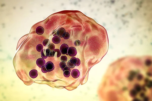 在活检标本的显微镜下看到的巨大多核细胞 被称为Warthin Finkeldey巨细胞 3D图像 也发现于Hiv感染者 在木村病 — 图库照片