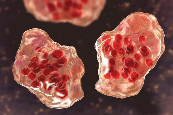 Meslingsykdom Store Multinukleerte Celler Sett Mikroskopi Biopsiprøver Kjent Som Warthin – stockfoto
