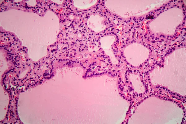Goitre Endémique Micrographie Photonique Hypertrophie Anormale Glande Thyroïde Due Une — Photo