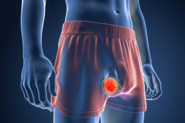 Testis kanseri, testis semineri, koriyokarsinom, teratom ya da testislerin diğer tümörleri, 3 boyutlu illüstrasyon