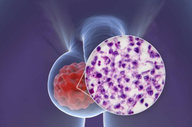 Testis kanseri, testis semineri, tıbbi 3 boyutlu illüstrasyon ve ışık mikrografı. Testisin kötü huylu tümörü