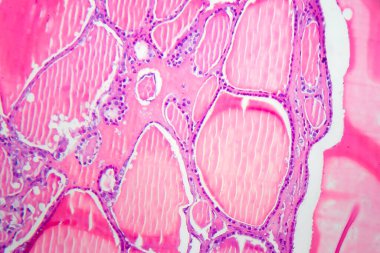 Tiroid bezinin foliküler adenomu, hafif mikrograf. Tidoid adenom hipopatolojisi. Fotoğraf mikroskop altında