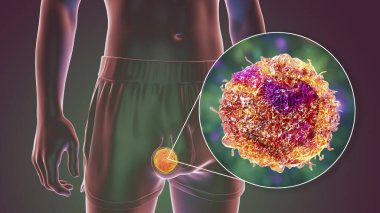 Testicular cancer, medical 3D illustration showing malignant tumor in the testis and close-up view of testicular cancer cell clipart