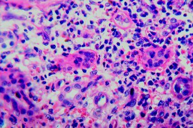 Kronik piyelonefrit, ışık mikrografı, mikroskop altında fotoğraf.