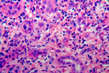 Kronik piyelonefrit, ışık mikrografı, mikroskop altında fotoğraf.