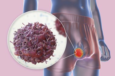 Testis kanseri, testislerde kötü huylu tümör ve testis kanseri hücresinin yakın plan görüntüsünü gösteren tıbbi 3 boyutlu çizimler.
