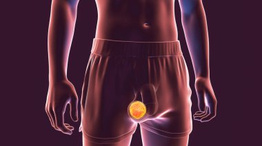 Testis kanseri, testis semineri, koriyokarsinom, teratom ya da testislerin diğer tümörleri, 3 boyutlu illüstrasyon