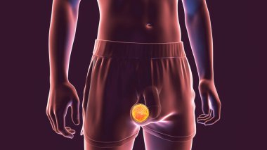 Testicular cancer, testicular seminoma, choriocarcinoma, teratoma or other tumor of the testis, 3D illustration clipart