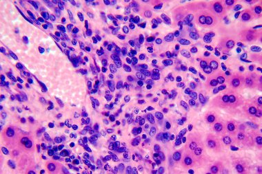 Coccidiosis, coccidia in liver, light micrograph, photo under mikroskop