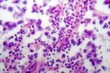 Testis semineri, ışık mikrografı, mikroskop altında fotoğraf. Testisin en yaygın germ hücresi tümörü.