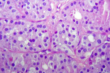 Tiroid bezinin foliküler adenomu, hafif mikrograf. Tidoid adenom hipopatolojisi. Fotoğraf mikroskop altında