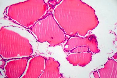 Tiroid kanseri, hafif mikrograf, mikroskop altında fotoğraf.