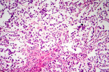 Testis semineri, ışık mikrografı, mikroskop altında fotoğraf. Testisin en yaygın germ hücresi tümörü.