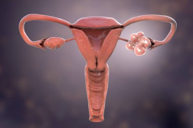 Polycystic ovary syndrome, 3D illustration showing healthy ovary (right) and enlarged ovary with cysts (left) clipart