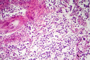 Testis semineri, ışık mikrografı, mikroskop altında fotoğraf. Testisin en yaygın germ hücresi tümörü.