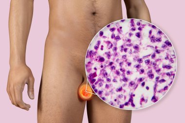 Testis kanseri, testis semineri, tıbbi 3 boyutlu illüstrasyon ve ışık mikrografı. Testisin kötü huylu tümörü