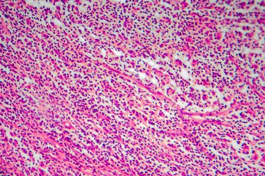 Hodgkin lenfoma, hafif mikrograf, mikroskop altında fotoğraf. Kanserin lenfositlerden kaynaklandığı bir tür lenfoma.