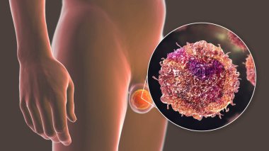 Testis kanseri, testislerde kötü huylu tümör ve testis kanseri hücresinin yakın plan görüntüsünü gösteren tıbbi 3 boyutlu çizimler.