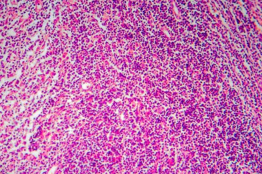 Hodgkin lenfoma, hafif mikrograf, mikroskop altında fotoğraf. Kanserin lenfositlerden kaynaklandığı bir tür lenfoma.