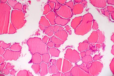 Tiroid kanseri, hafif mikrograf, mikroskop altında fotoğraf.