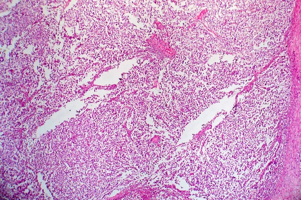 Seminoma Testicular Micrografía Ligera Foto Bajo Microscopio Tumor Células Germinativas — Foto de Stock